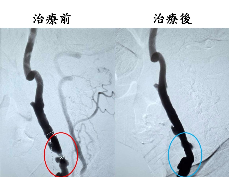 小心!頭暈背後可能是中風警訊