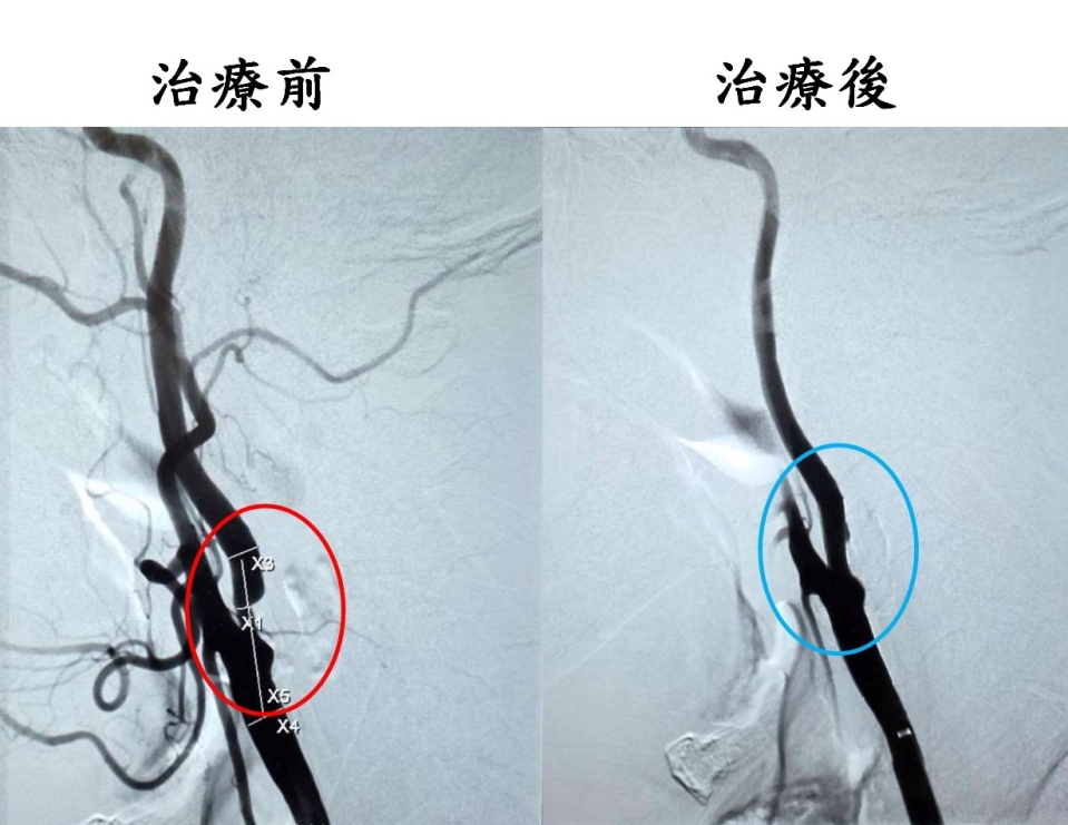 苗栗縣首例!85歲嬤吃7種藥 血壓仍失控 大千新技術助改善